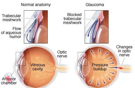 Open-angle glaucoma