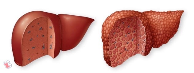 Normal liver and liver cirrhosis