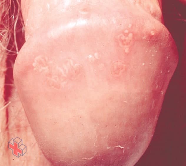 Photograph of genital herpes blisters on a penis