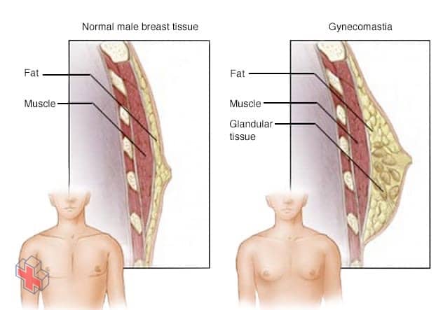 Enlarged breasts in men (gynecomastia)