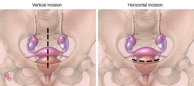 Vertical, horizontal abdominal hysterectomy incisions
