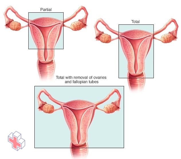 Types of hysterectomy surgery