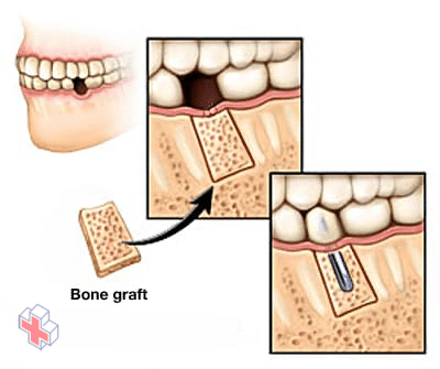 Bone grafting in the jawbone