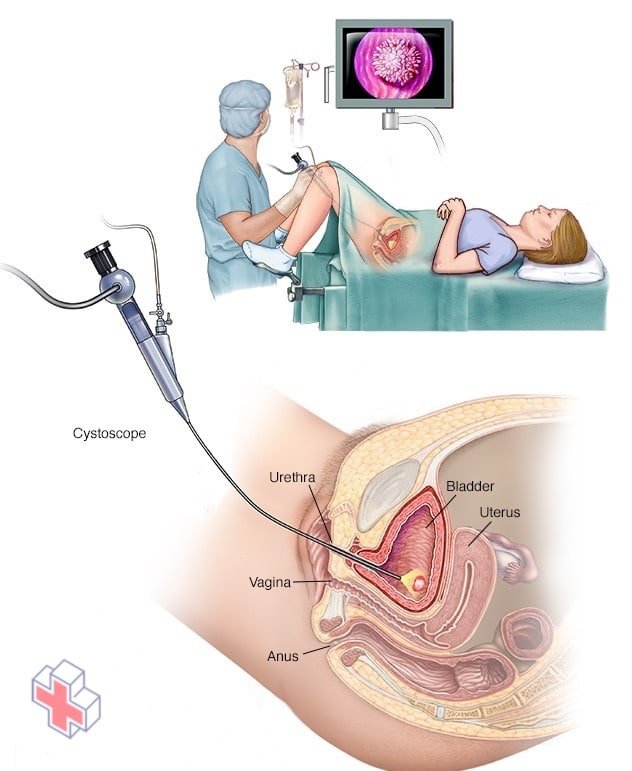 Cystoscopy performed on a woman