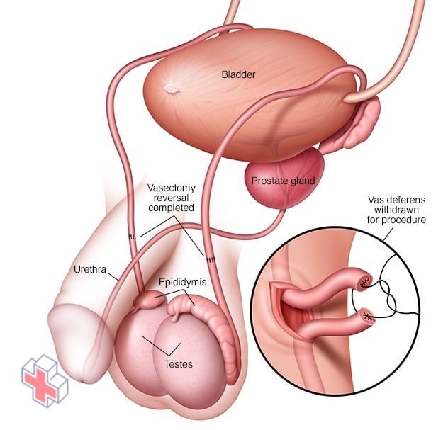 Vasectomy reversal procedure