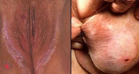 Lichen sclerosus in genital area