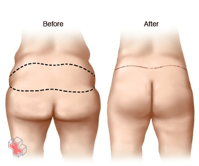 Illustration of buttock lift results