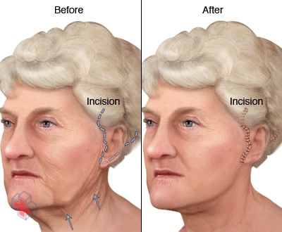 Illustration of a face-lift