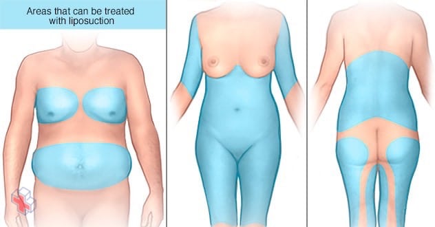 Areas on the abdomen, chest, back, legs and arms that can be treated with liposuction