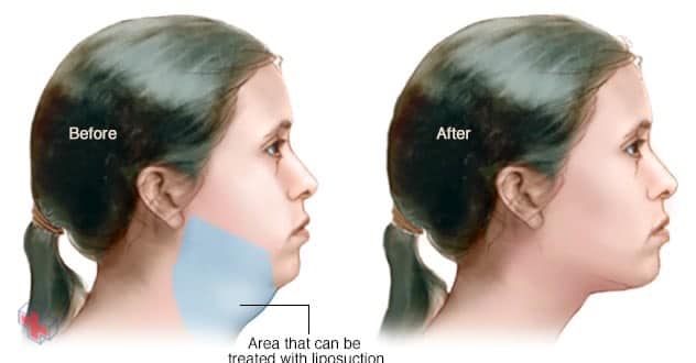 Area under chin that can be treated with liposuction