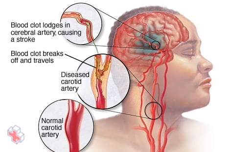 Illustration showing ischemic stroke