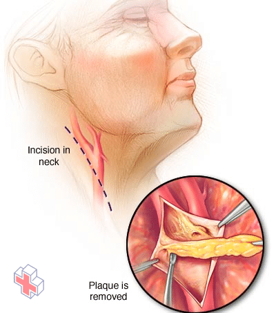 Steps of carotid endarterectomy