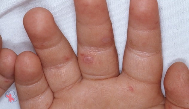 Rash on the hand caused by hand-foot-and-mouth disease