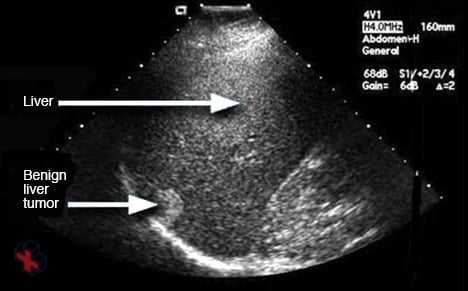 Ultrasound image of a liver tumor