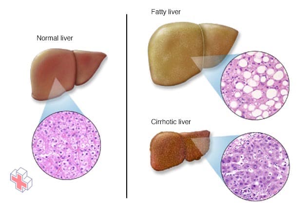 Liver problems showing normal and diseased livers