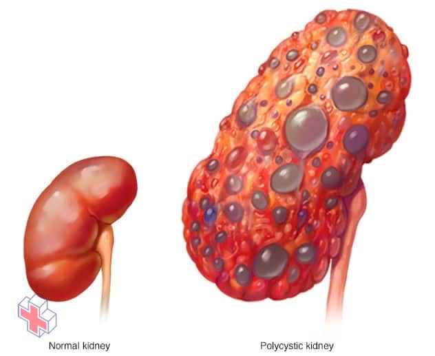Polycystic kidney compared with normal kidney