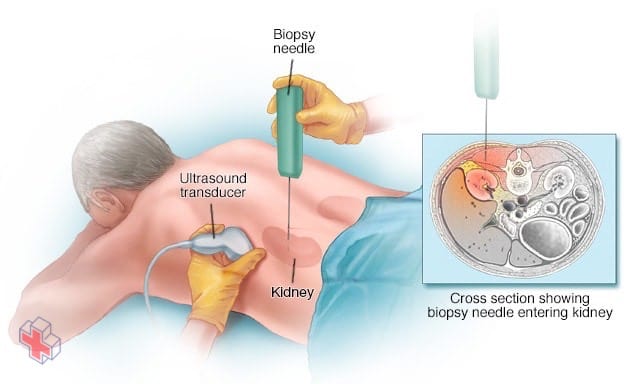 Kidney biopsy procedure