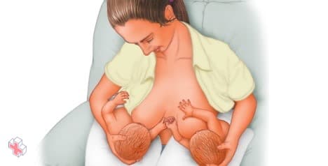 Woman breast-feeding twins with football hold