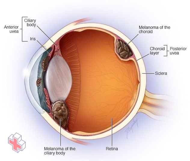 Illustration showing where eye melanoma occurs