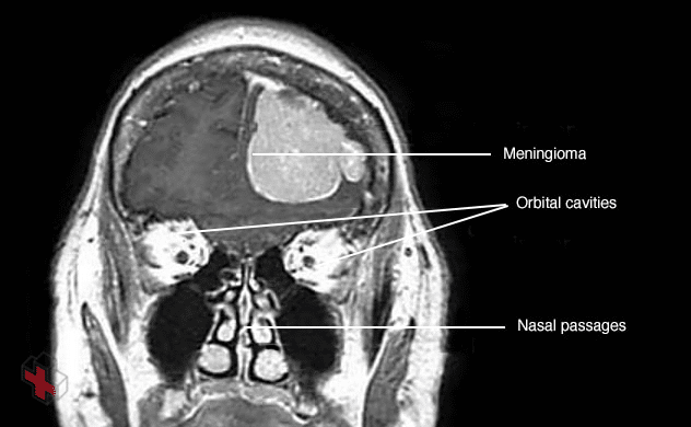 Computerized tomography (CT) scan showing a meningioma