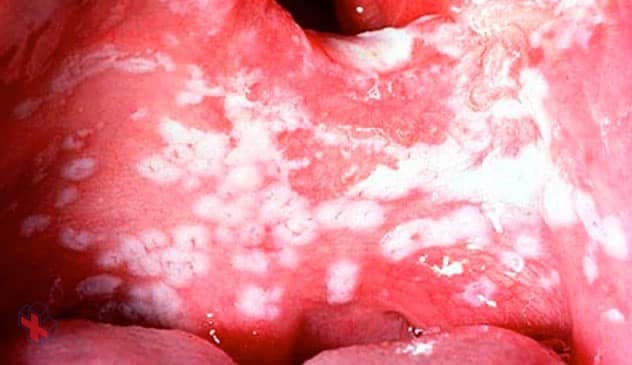 Photograph showing patches of oral thrush on the tongue.