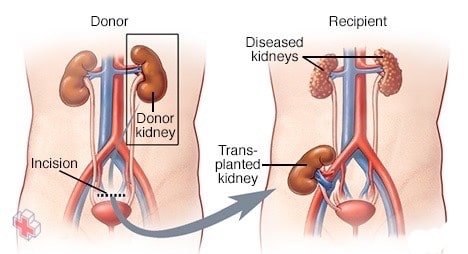Living kidney donor laparoscopic nephrectomy
