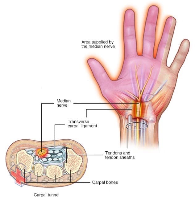 Pinched nerve in wrist