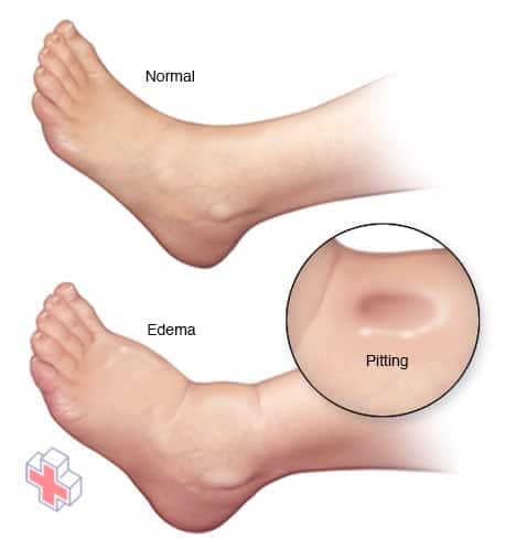 Edema in foot and ankle