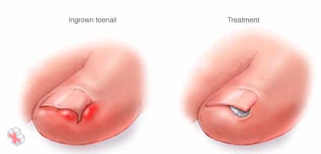 Illustration showing ingrown toenail treatment
