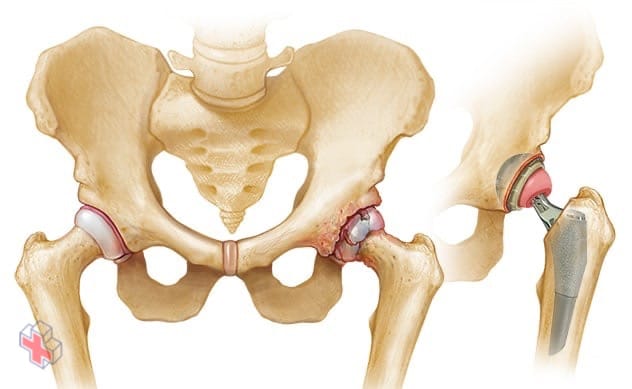 Hip affected by osteoarthritis before and after hip replacement