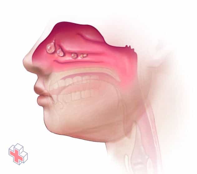 Nasal polyps in the nose and sinuses