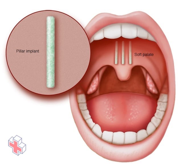 A pillar implant and where it's placed in the soft palate