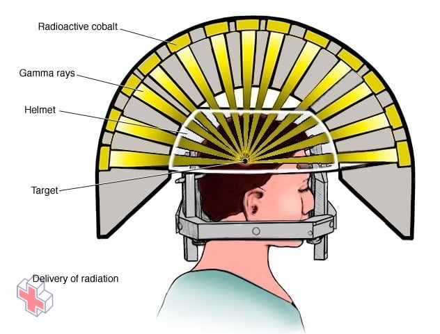 The headpiece and gamma ray delivery
