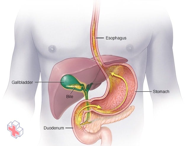 Bile reflux into the stomach and esophagus