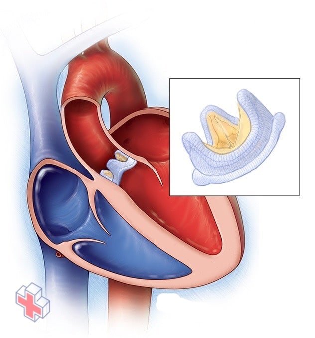 Biological valve replacement