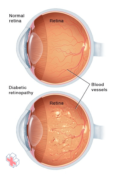 Severe nonproliferative diabetic retinopathy