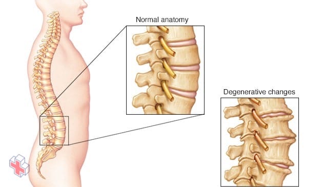 Bone spurs and narrowed disks in the spine