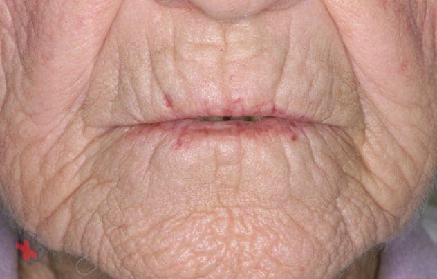Woman's face with telangiectasias