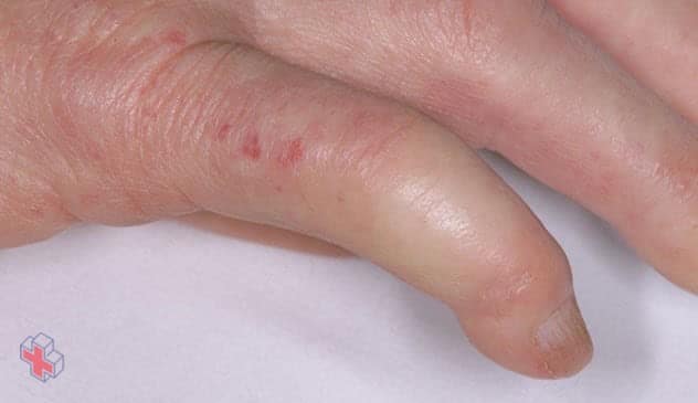 Finger affected by limited scleroderma