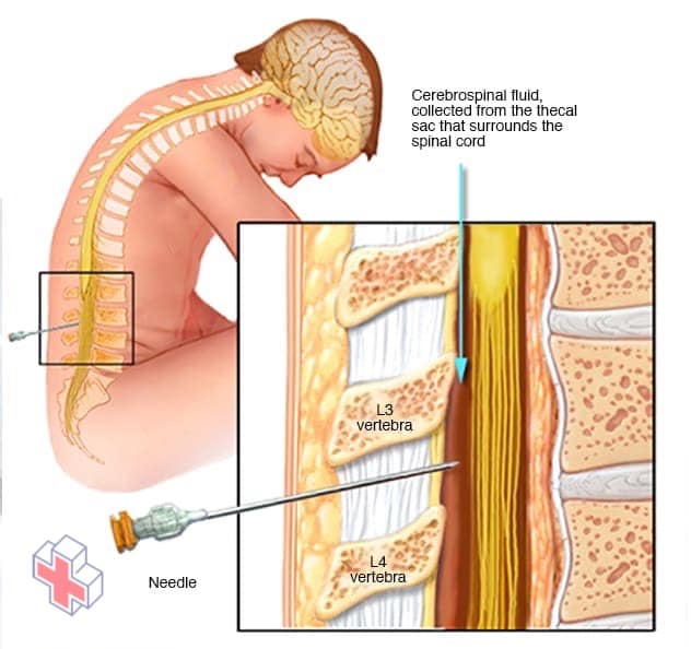 Spinal tap (lumbar puncture)