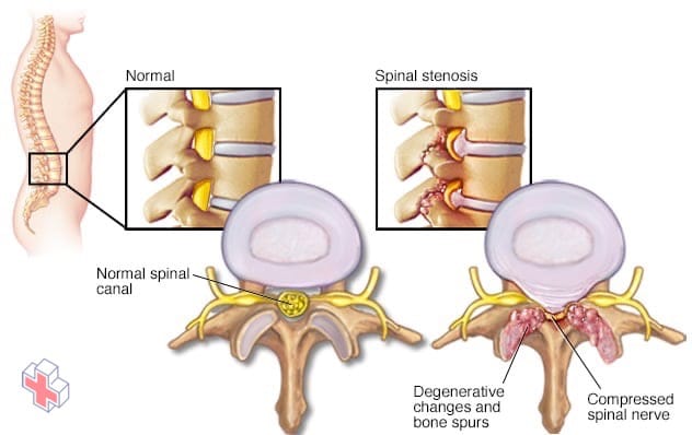 How spinal stenosis can compress spinal nerves.