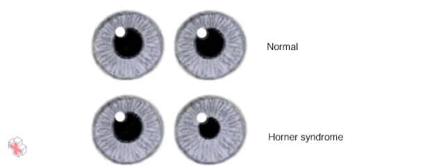 Horner syndrome signs