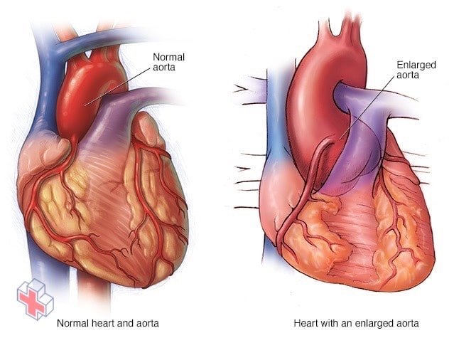 Aneurysm at aortic root