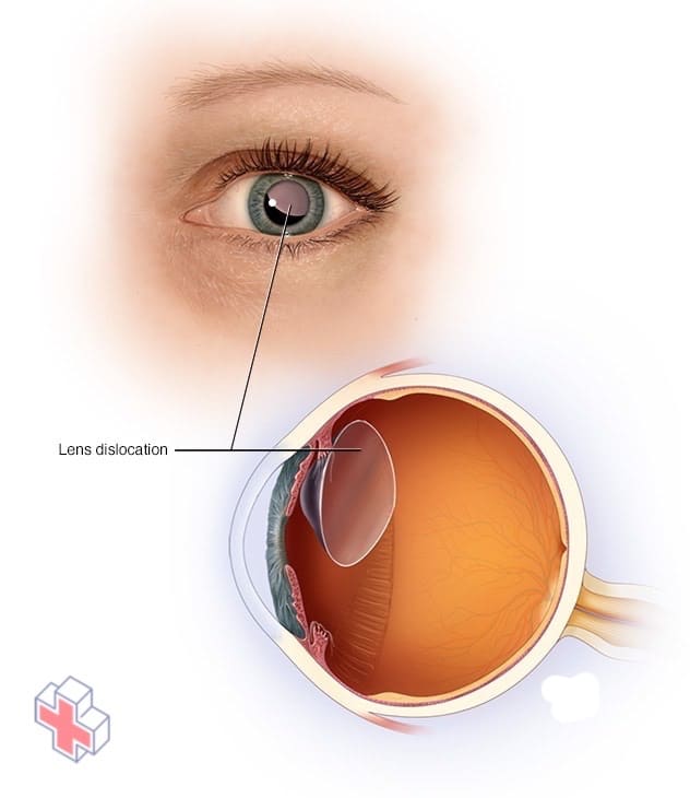 A dislocated lens within the eye