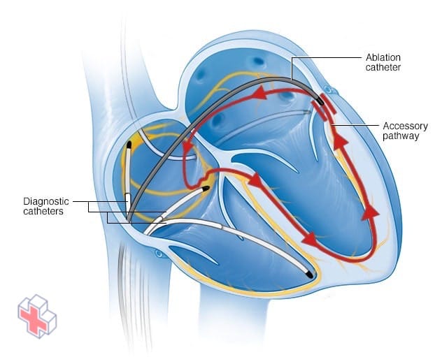 Cardiac catheter ablation