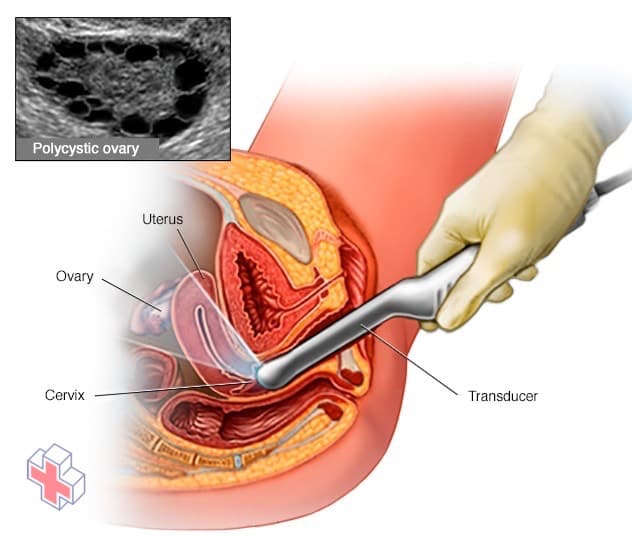 Transvaginal ultrasound exam