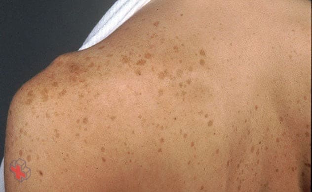 Age spots on the shoulder and back
