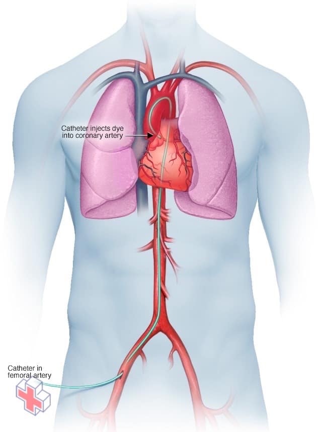 Catheterization for a coronary angiogram