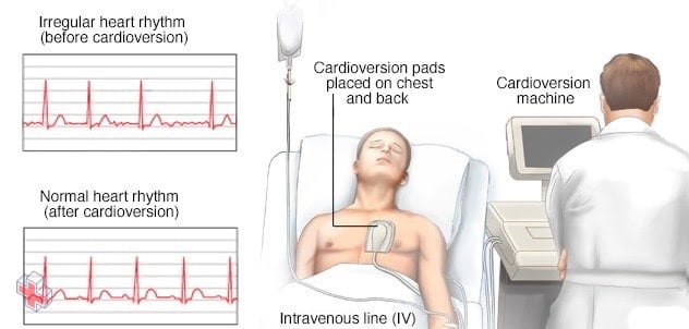 Person undergoing cardioversion