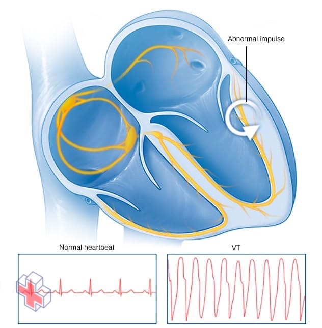 Ventricular tachycardia heartbeat